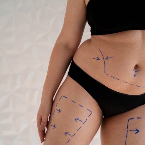 Body Contouring