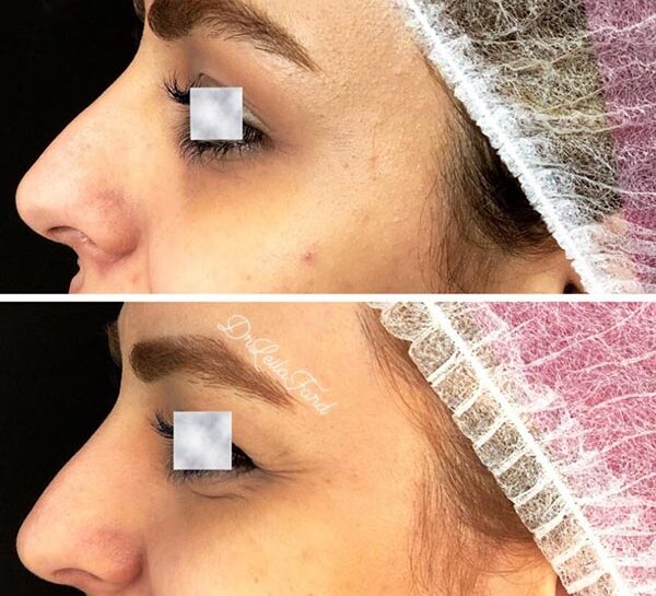 botox-ba2