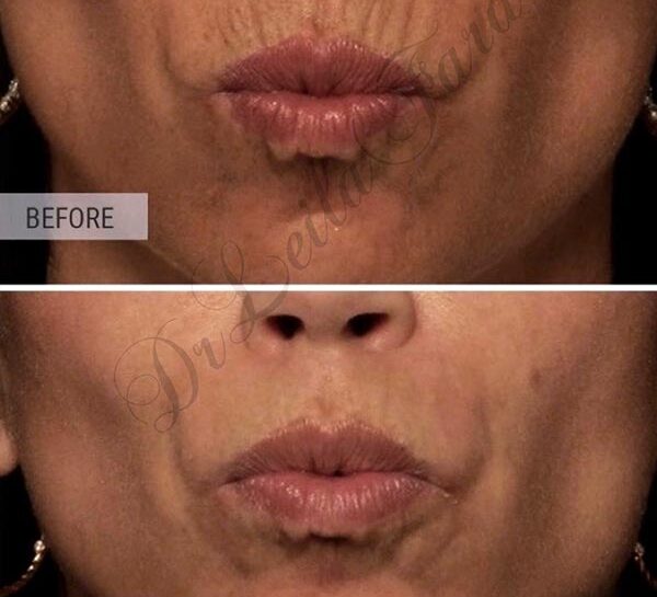botox-ba5