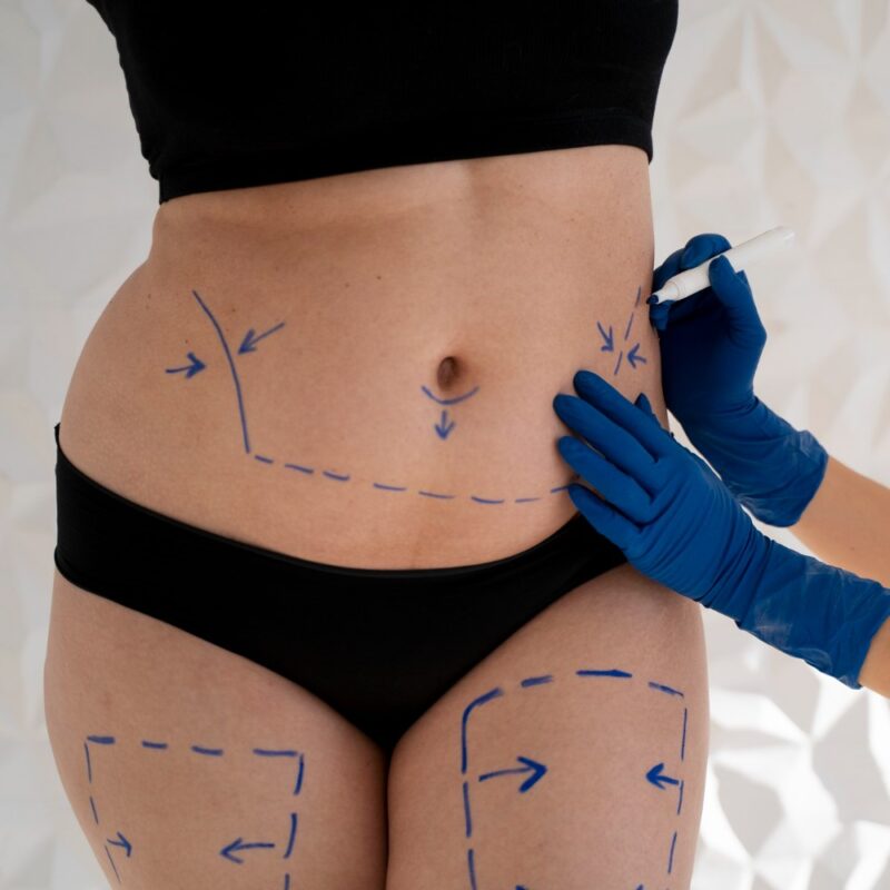 body contouring