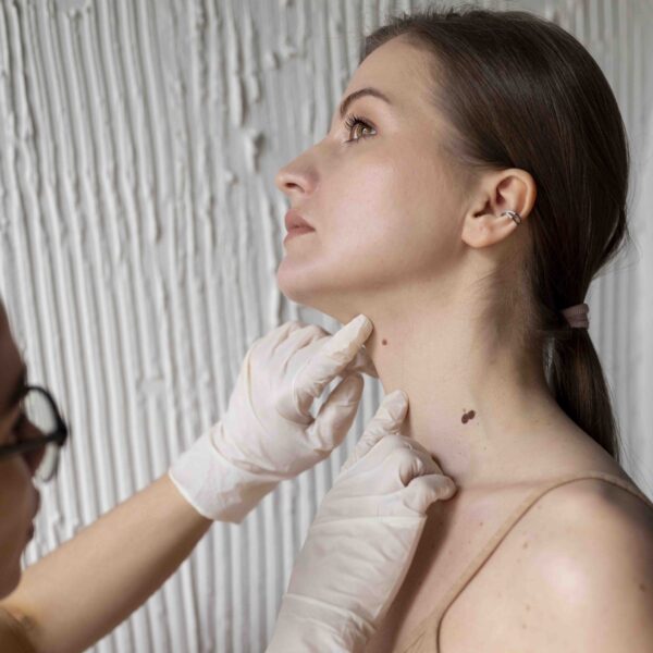 Hyperpigmentation Treatment
