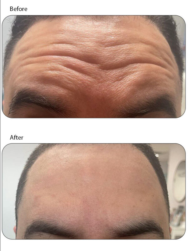 botox2